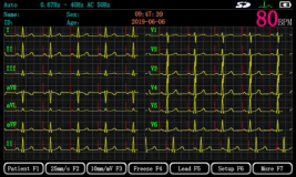 ECG MACHINE 3 CHAN  (ECGMAC-EM301)  EA