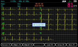 ECG MACHINE 3 CHAN  (ECGMAC-EM301)  EA