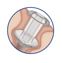 P/PLUG PRE-LOAD SOFT PLUG 0.5MM (OASIS-6611) PK/2