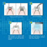 TheraCal PT Pulpotomy Treatment 4gm