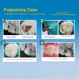 TheraCal PT Pulpotomy Treatment 4gm