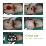 TheraCal PT Pulpotomy Treatment 4gm