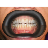 Vision Butler Large Mouth Retractor