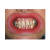 Vision Butler Extra Small Pink Mouth Retractor