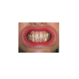 Vision Butler Extra Small Pink Mouth Retractor