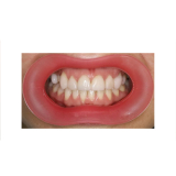 Vision Butler Medium Pink Mouth Retractor