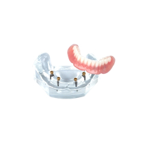 Locator 4 Implant Overdenture Patient Model
