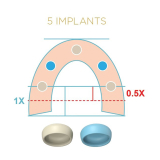 Locator Fixed Blue Mid-Arch Insert for 5+ Implants 2pk