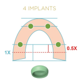 Locator Fixed Green Insert for 4 Unit Implant Cases 2pk