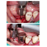 MD Guide Implant Drill Kit